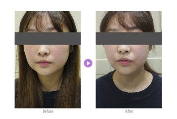 윤곽주사01.jpg